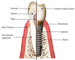 Tooth implants Chicago